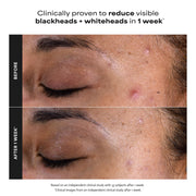 Paula's Choice SKIN PERFECTING 2% BHA Liquid Leave-On Exfoliant | Gentle Salicylic Acid Leave-On Facial Exfoliator for Blackheads, Enlarged Pores, Wrinkles & Fine Lines