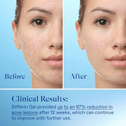 Differin Acne Retinoid Treatment Gel, 0.1% Adapalene, 15g Tube | Over-The-Counter Retinoid, Clears Acne And Prevents Breakouts, Gentle For Sensitive Skin, 30-Day Supply, 15G Tube