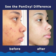 PanOxyl Acne Foaming Wash, 10% Benzoyl Peroxide, For Face & Body, 5.5 oz | Maximum Strength, Antibacterial Daily Cleanser, Treats & Prevents Acne, Non-Comedogenic, Vegan, Unscented, All Skin Types